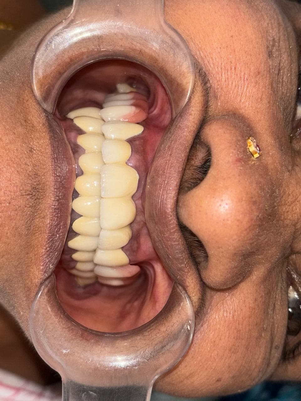 Dental Crown Set