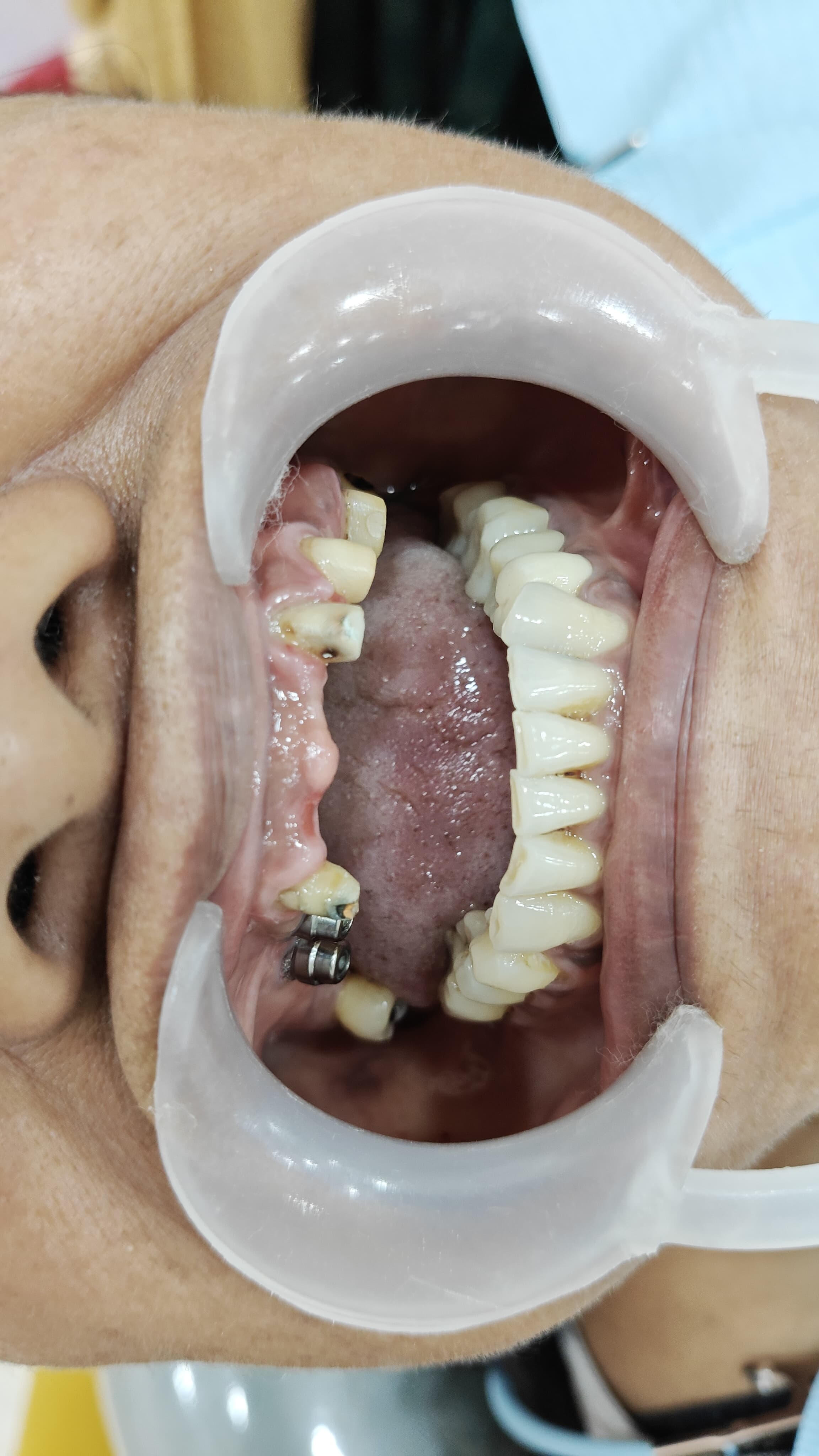 Implant Surgery