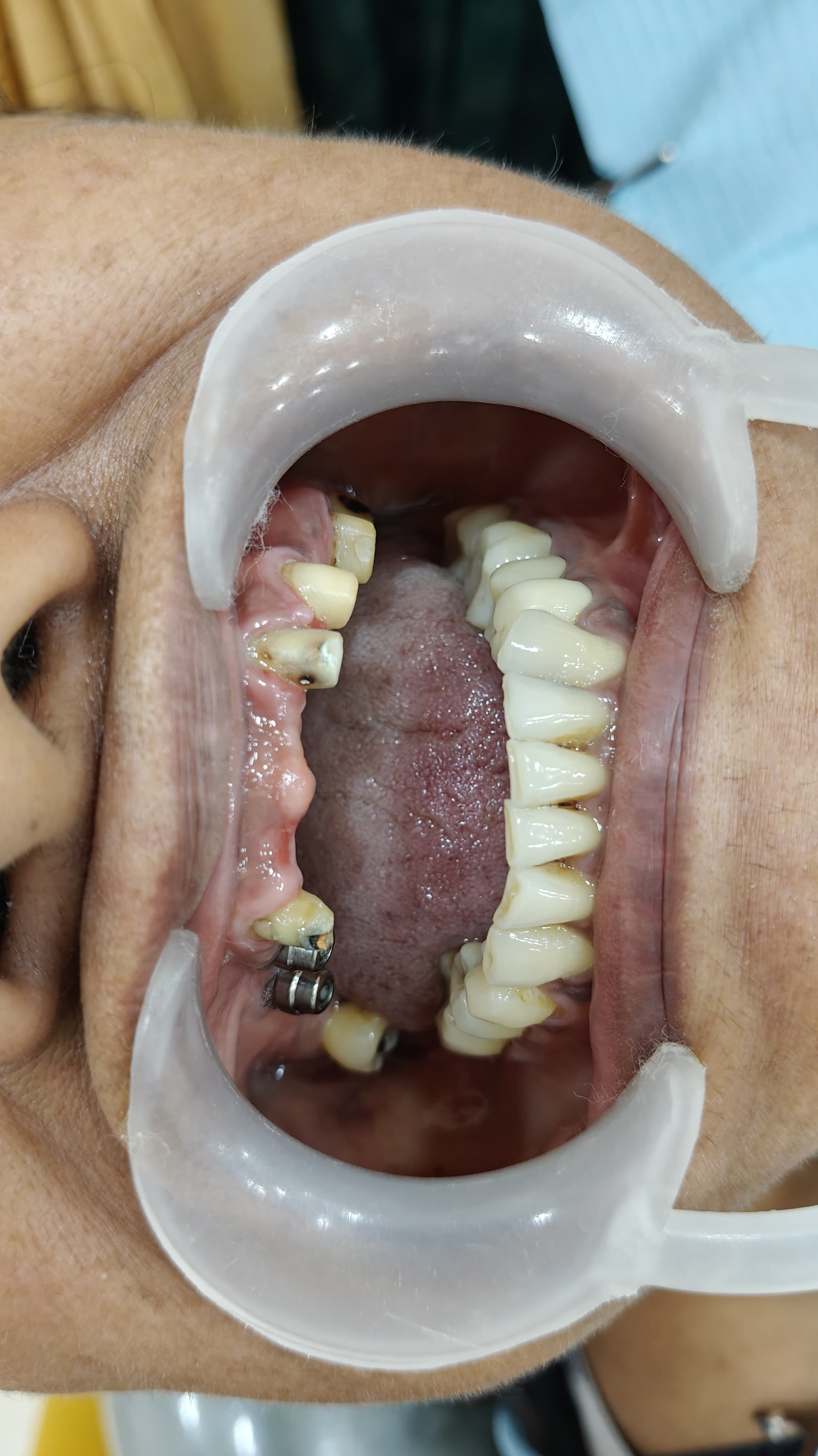 Implant Placement