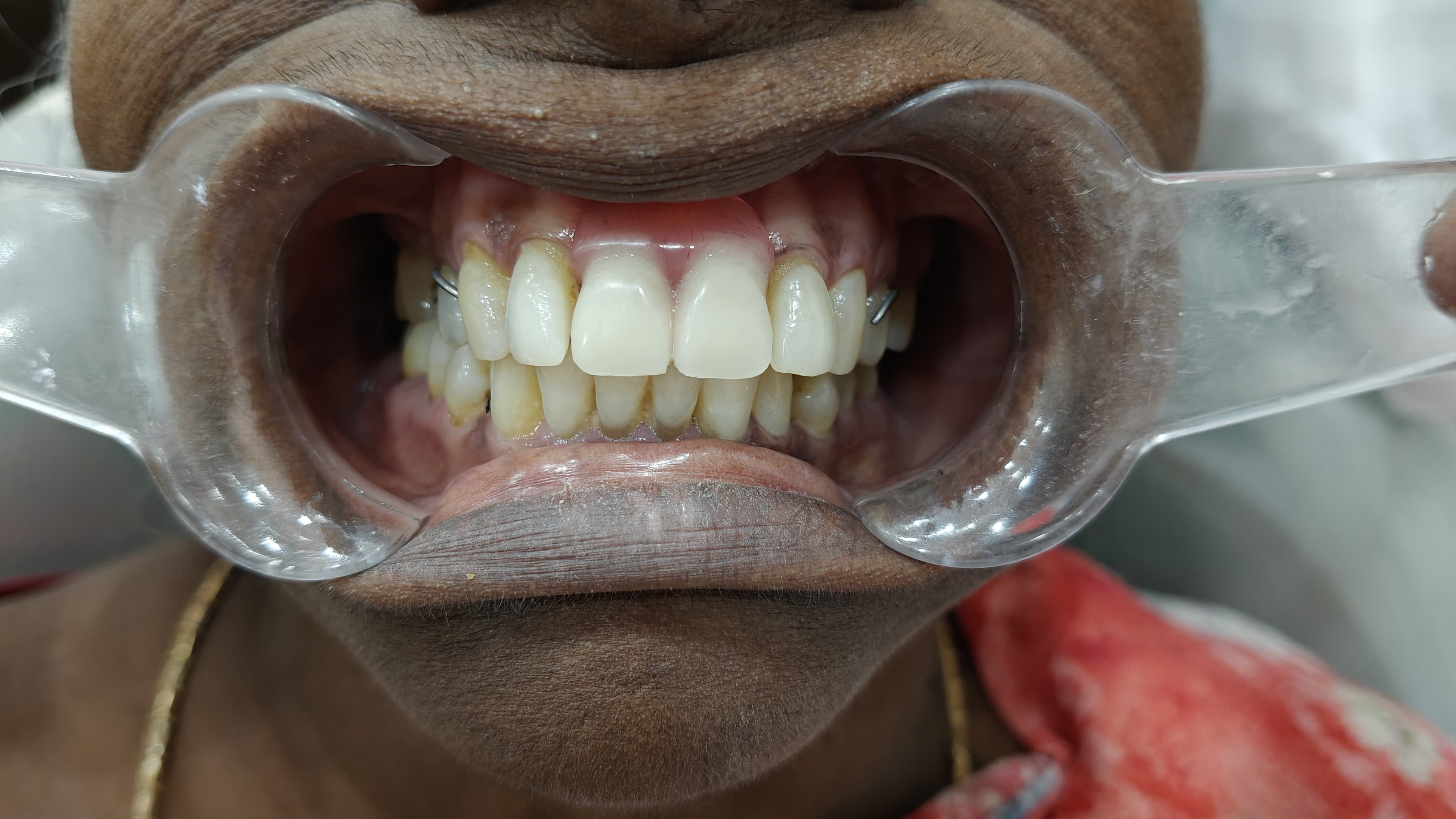 Dental Crown Result