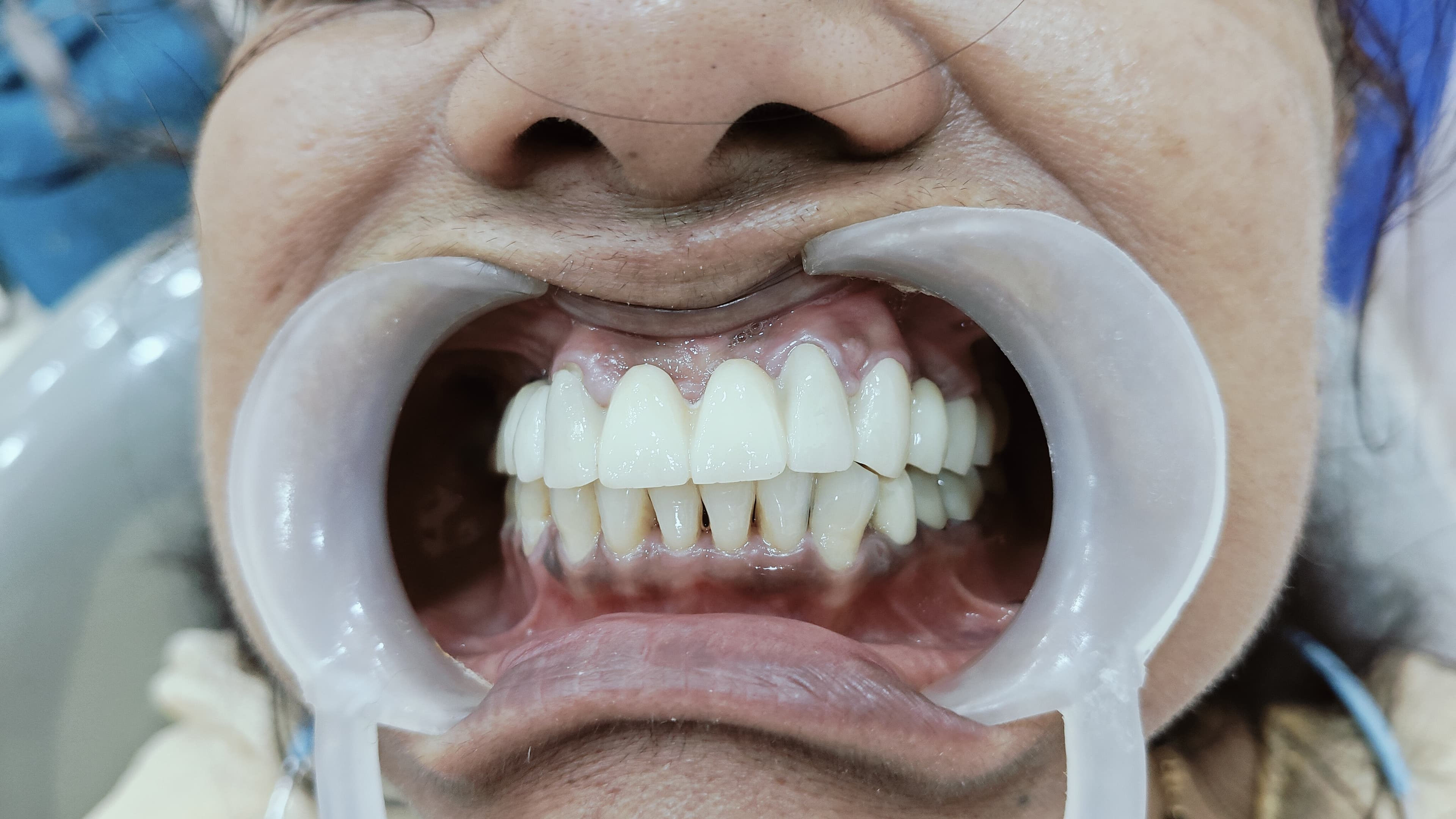 Full Smile Rehabilitation