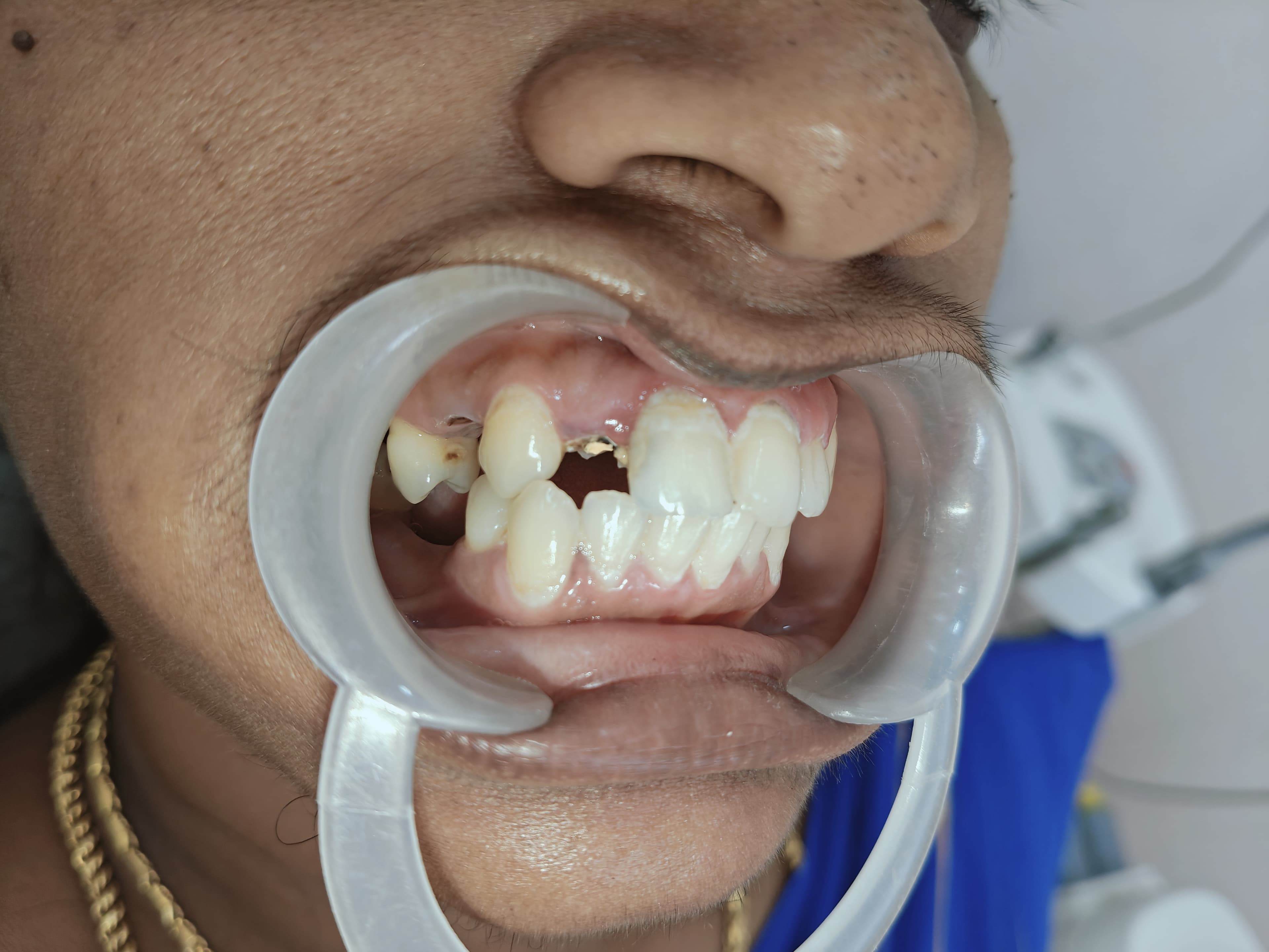 Implant Assessment