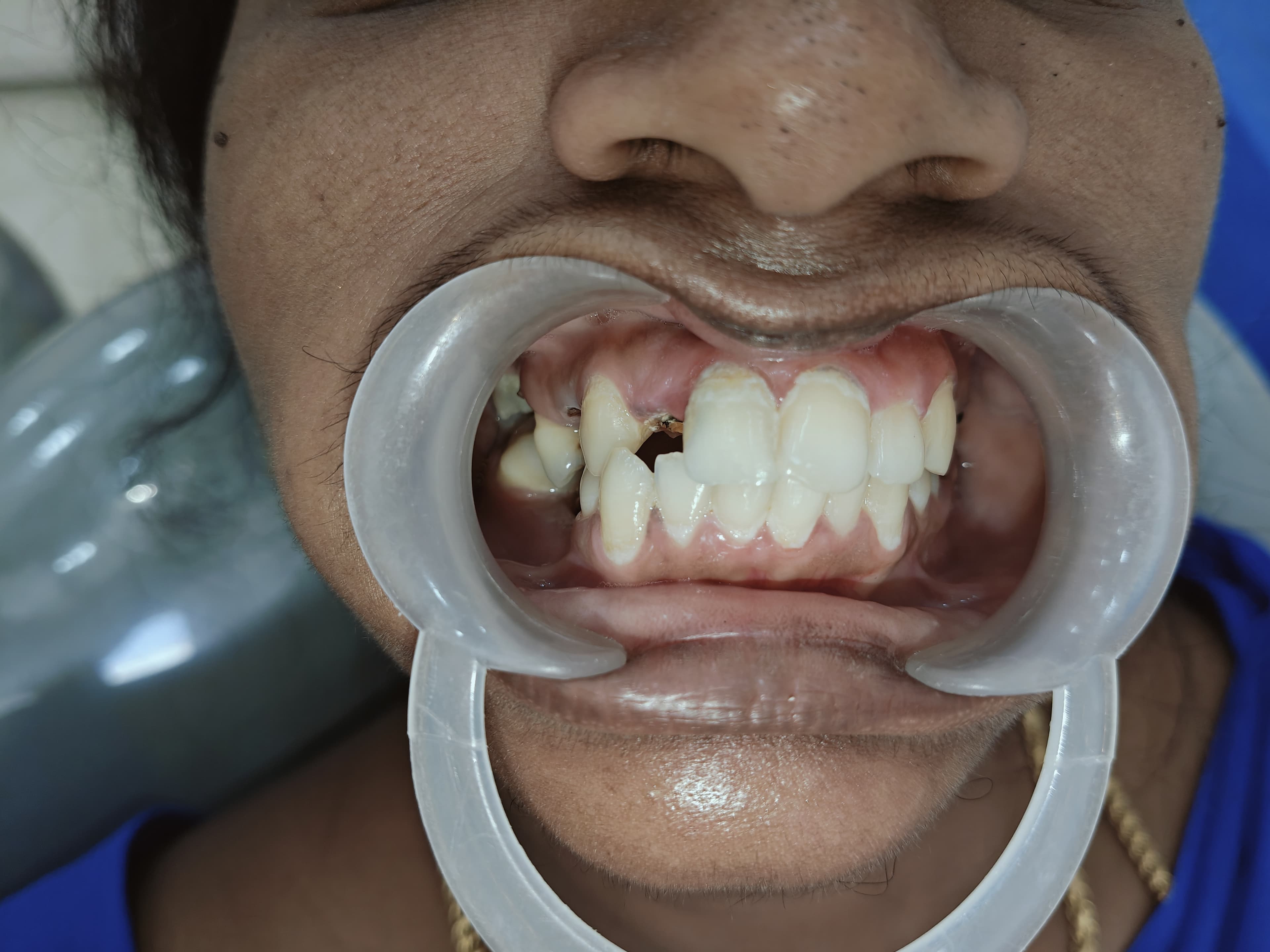 Implant Case