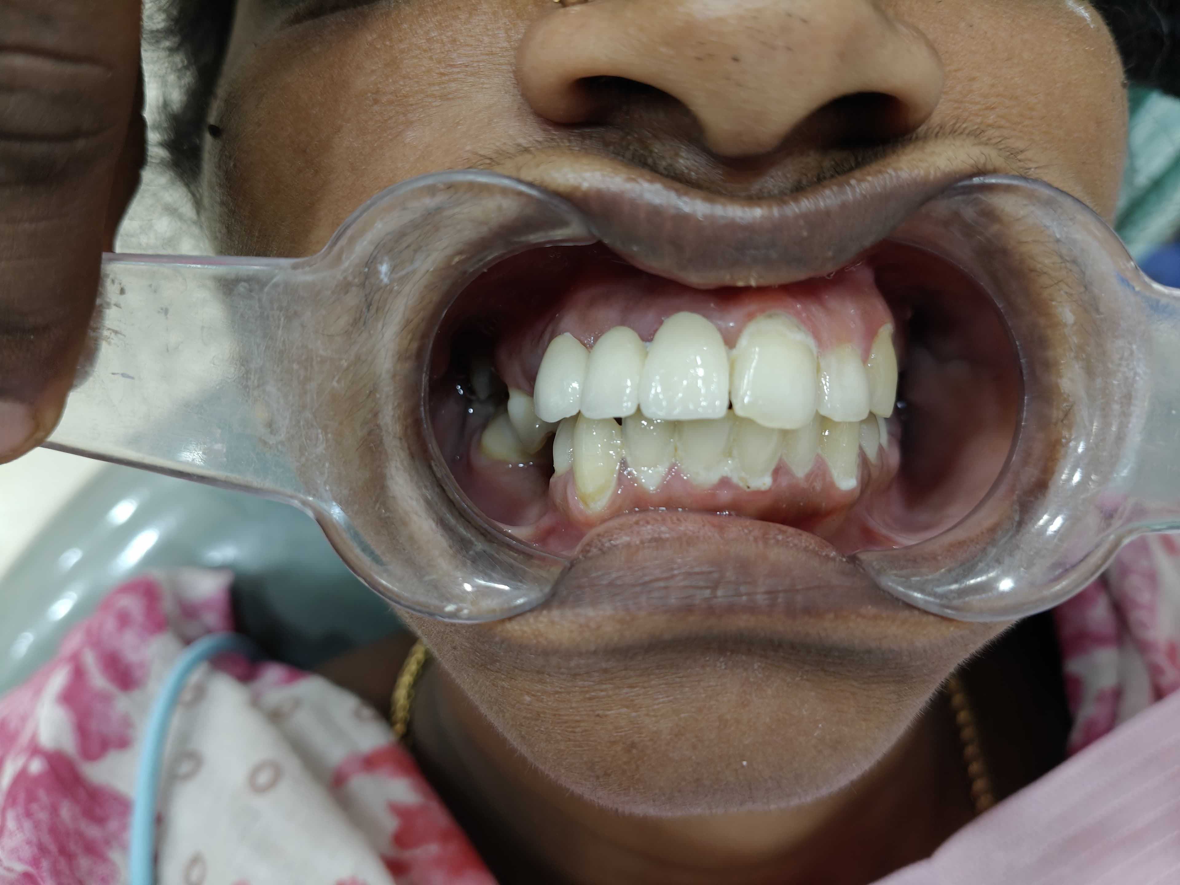 Smile Makeover