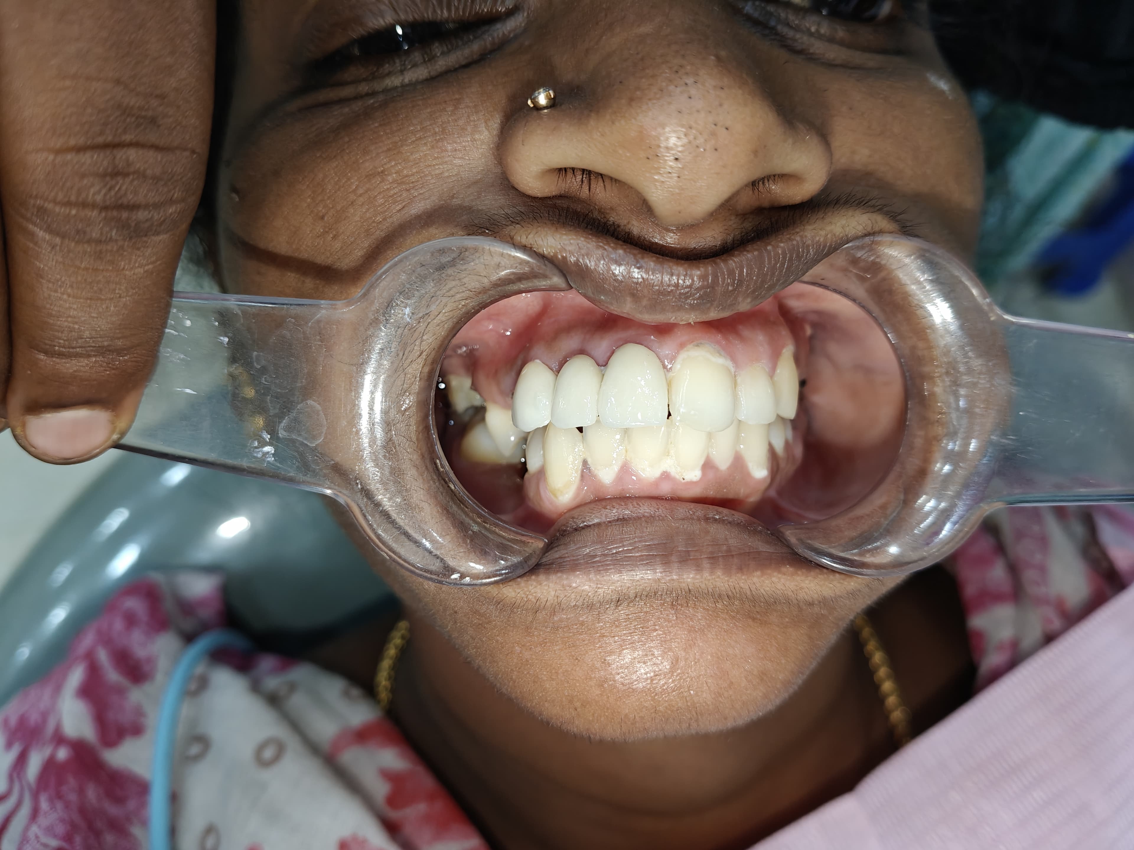 Post-Treatment Smile