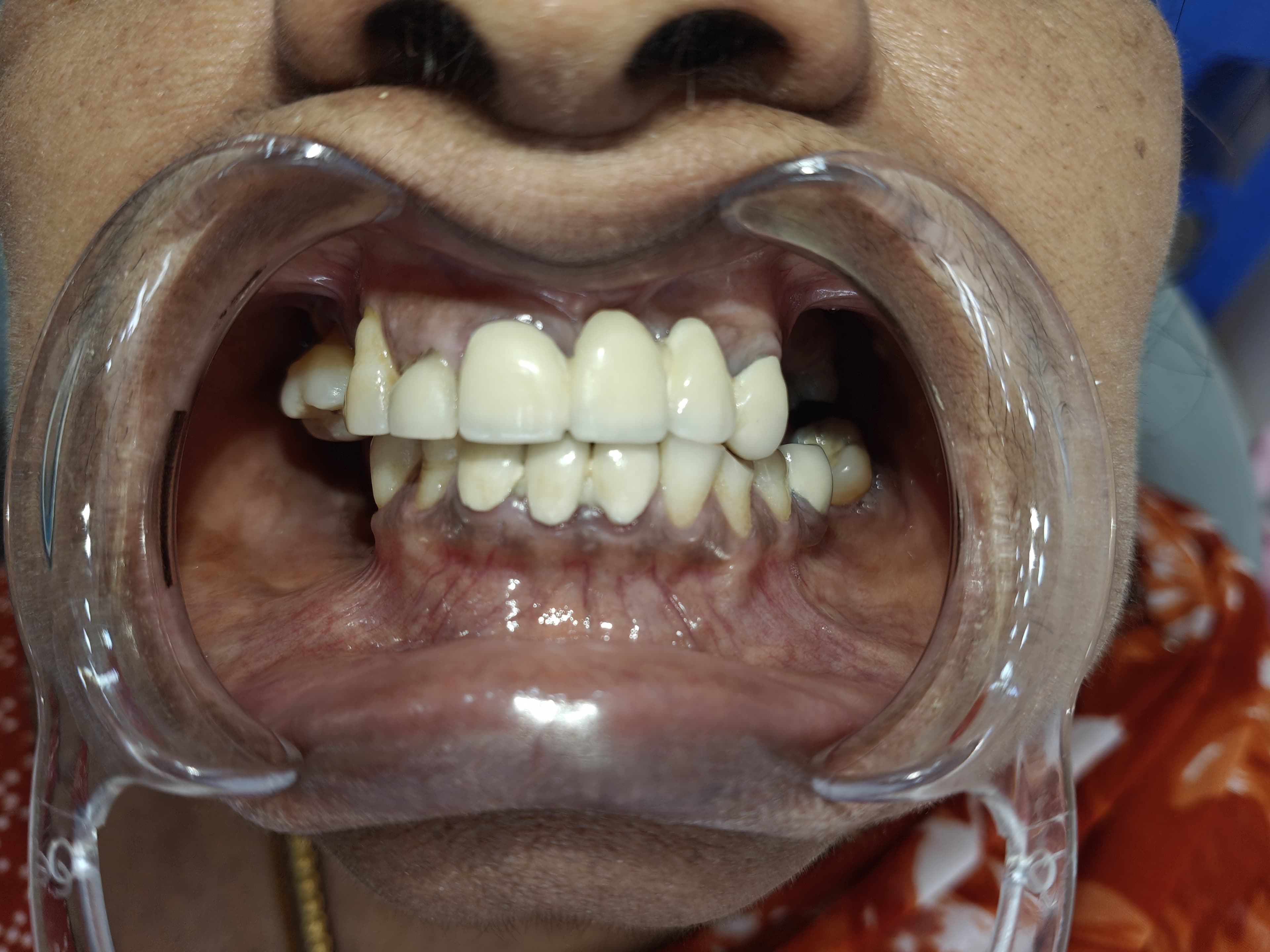 Smile Transformation