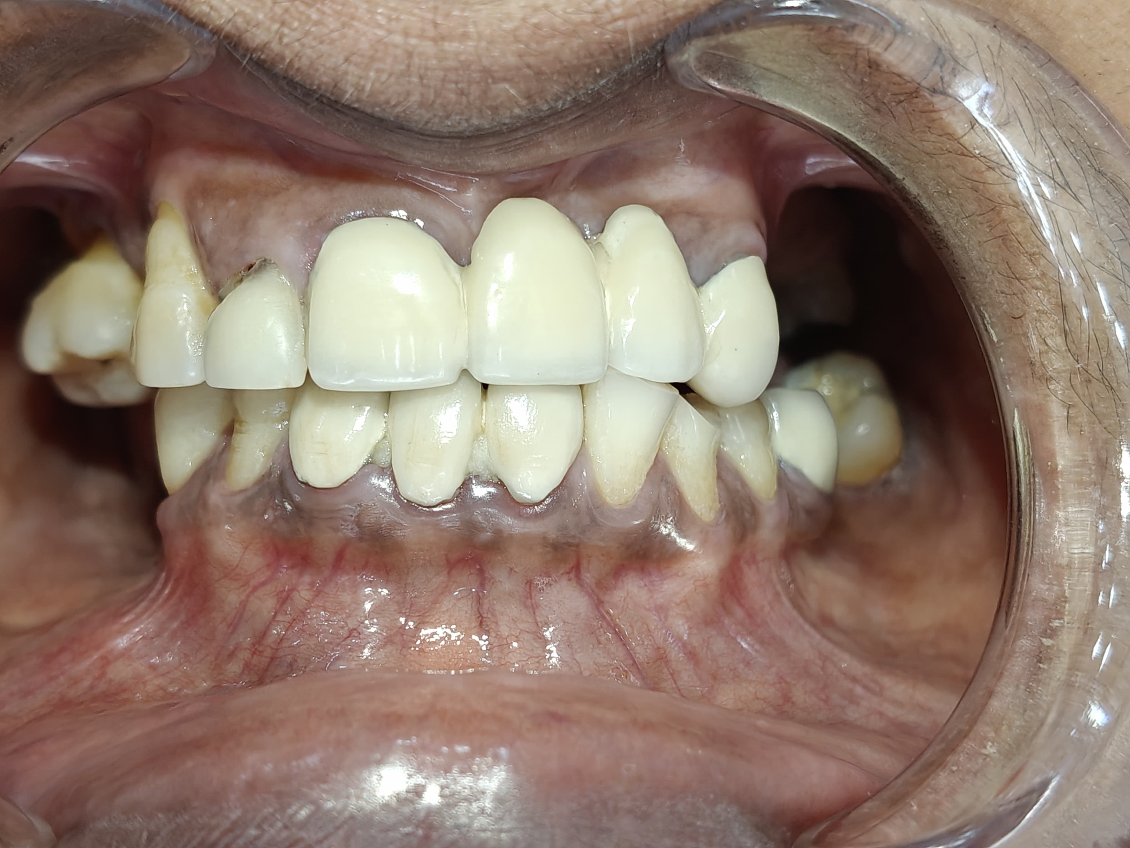 Dental Bridge Result