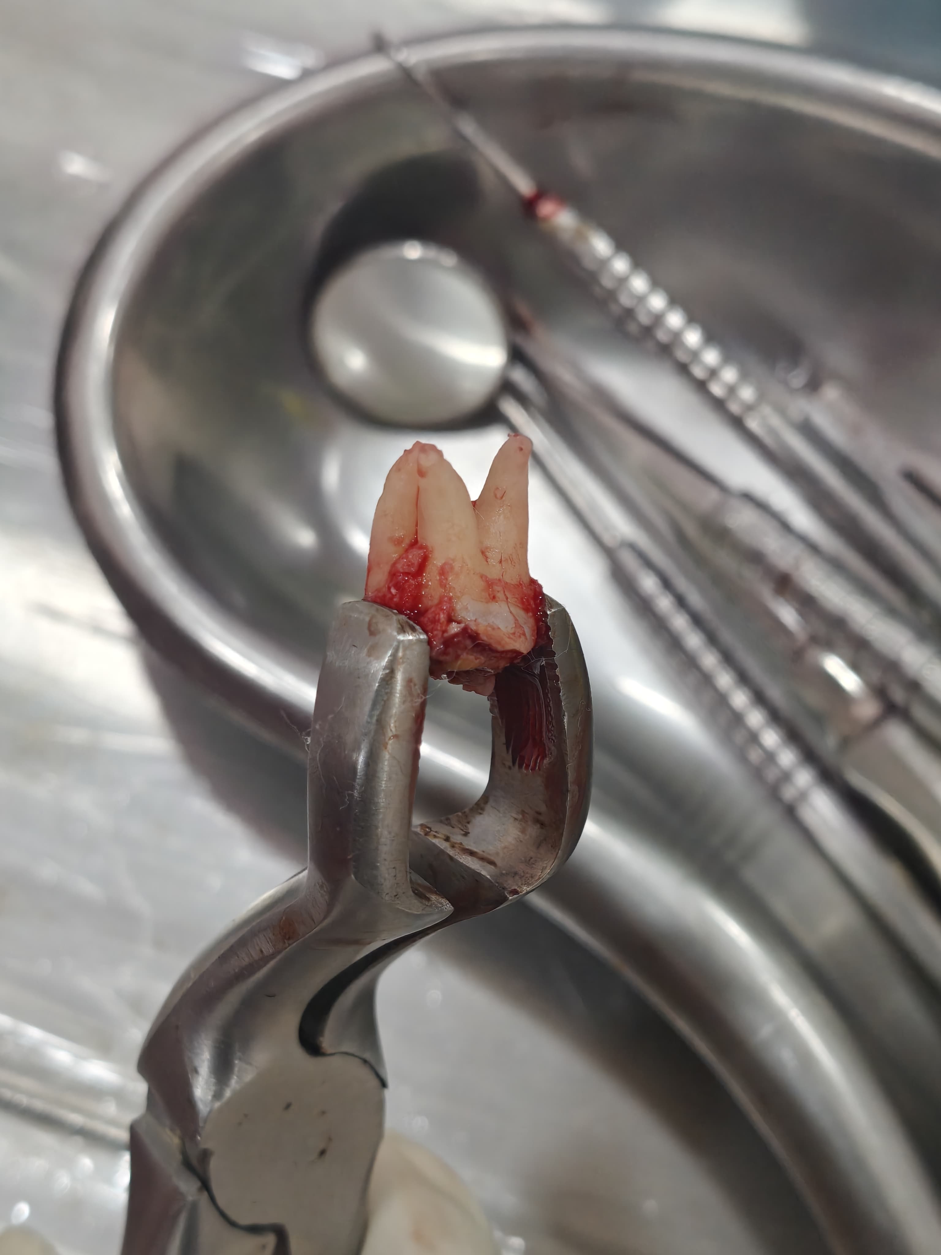 Tooth Extraction
