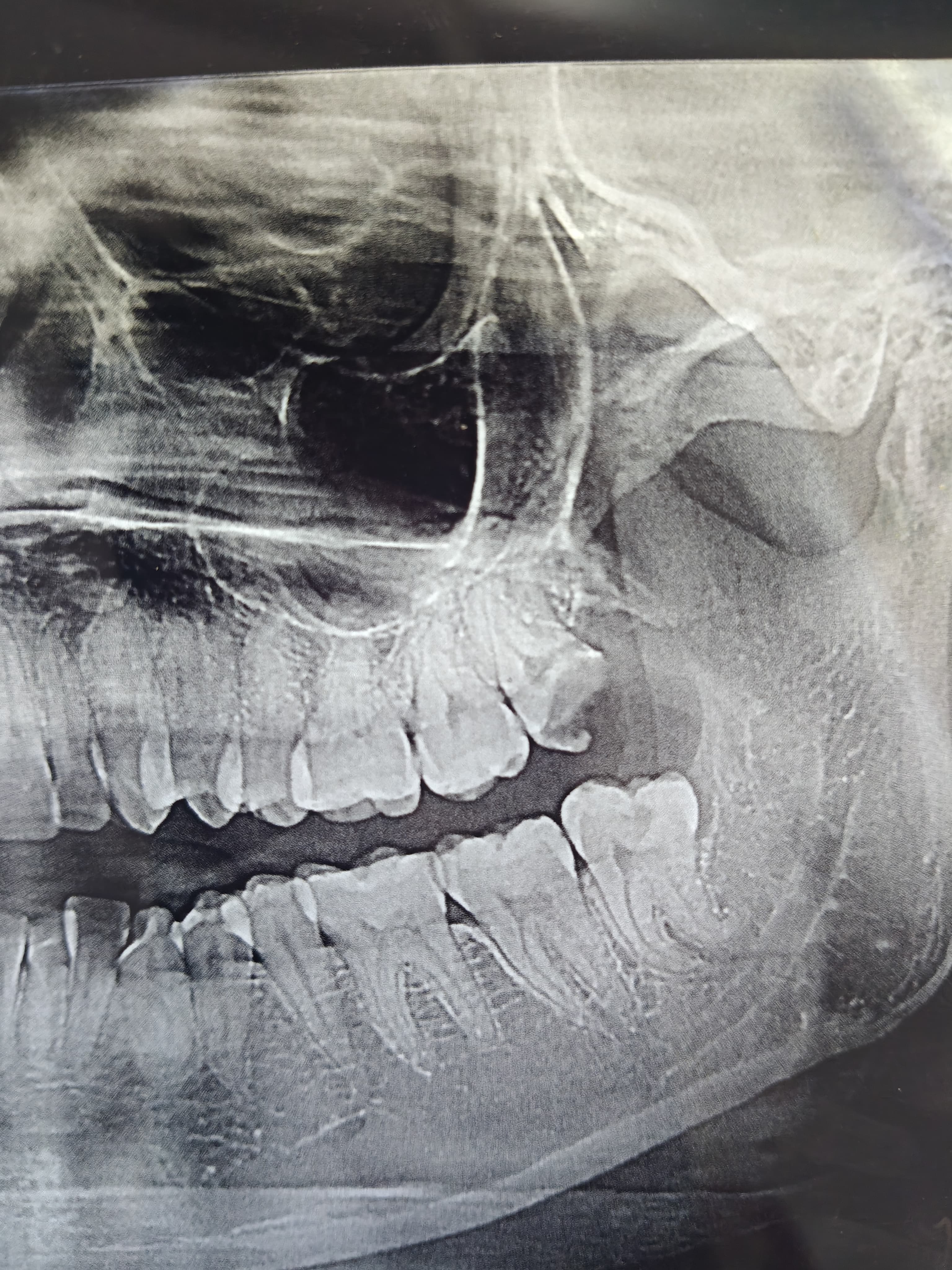 Dental X-Ray